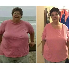 Sheryl S. – Bariatrics Gastric Sleeve Surgery