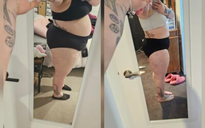 Dena – RNY Gastric Bypass Surgery