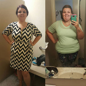 Before and After Gallery | Go Light Bariatrics