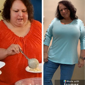 Rhonda T. – Bariatrics Gastric Bypass Surgery