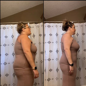 Amber – Bariatrics Gastric Sleeve Surgery