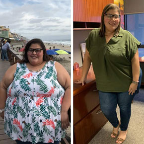 Julissa R. – Bariatrics Gastric Sleeve Surgery