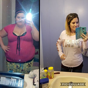 Kayla O. – Bariatrics Gastric Sleeve Surgery