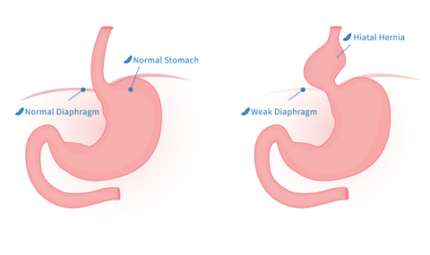 Hiatal Hernia Repair | Go Light Bariatrics