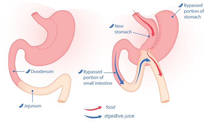 Mini gastric bypass illustration surgery options