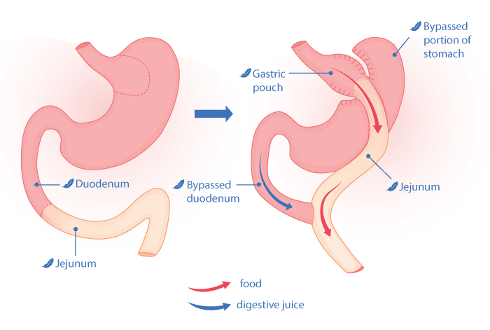 Rny gastric bypass illustration surgery options