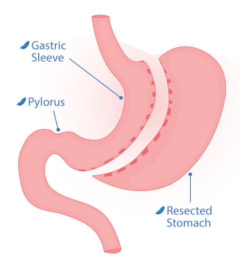 Gastric Sleeve (VSG) | Go Light Bariatrics