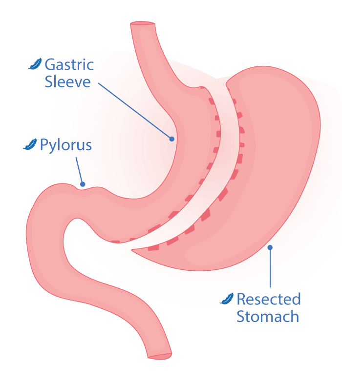 A diagram of stomach with a gastric sleeve and a pylorus