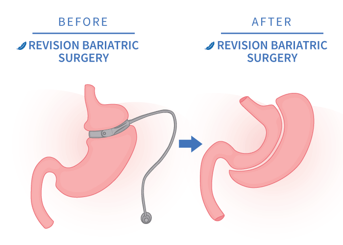 Revision bariatric surgery before and after illustration surgery options