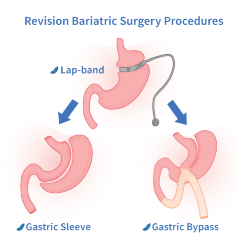 Revision Bariatric Surgery | Go Light Bariatrics