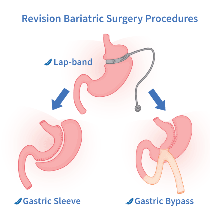 Revision bariatric surgery procedures illustration surgery options